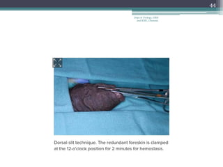 44
Dept of Urology, GRH
and KMC, Chennai.
 