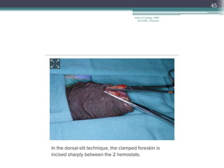 45
Dept of Urology, GRH
and KMC, Chennai.
 