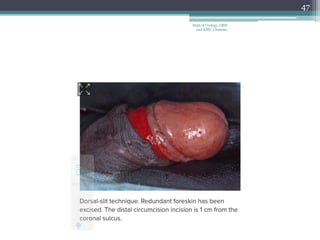 47
Dept of Urology, GRH
and KMC, Chennai.
 