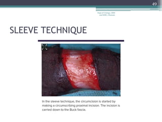 SLEEVE TECHNIQUE
49
Dept of Urology, GRH
and KMC, Chennai.
 