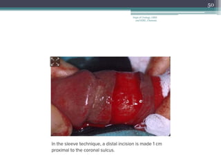 50
Dept of Urology, GRH
and KMC, Chennai.
 