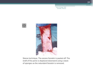 52
Dept of Urology, GRH
and KMC, Chennai.
 