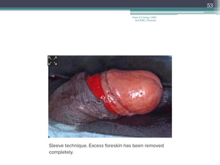 53
Dept of Urology, GRH
and KMC, Chennai.
 