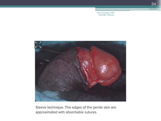 54
Dept of Urology, GRH
and KMC, Chennai.
 