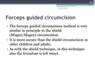Forceps guided circumcision
• The forceps guided circumcision method is very
similar in principle to the shield
(Mogen/Magen) circumcision.
• It is more secure than the shield circumcision in
older children and adults.
• As with the shield technique, in this technique
also the frenulum is left intact.
55
Dept of Urology, GRH
and KMC, Chennai.
 