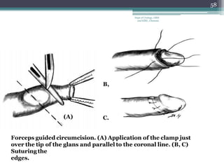 Forceps guided circumcision. (A) Application of the clamp just
over the tip of the glans and parallel to the coronal line. (B, C)
Suturing the
edges.
(A)
B,
C.
58
Dept of Urology, GRH
and KMC, Chennai.
 