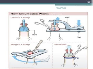 59
Dept of Urology, GRH
and KMC, Chennai.
 