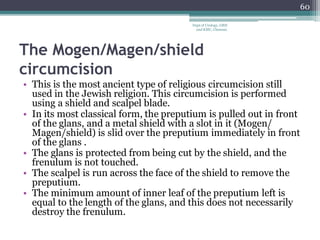 The Mogen/Magen/shield
circumcision
• This is the most ancient type of religious circumcision still
used in the Jewish religion. This circumcision is performed
using a shield and scalpel blade.
• In its most classical form, the preputium is pulled out in front
of the glans, and a metal shield with a slot in it (Mogen/
Magen/shield) is slid over the preputium immediately in front
of the glans .
• The glans is protected from being cut by the shield, and the
frenulum is not touched.
• The scalpel is run across the face of the shield to remove the
preputium.
• The minimum amount of inner leaf of the preputium left is
equal to the length of the glans, and this does not necessarily
destroy the frenulum.
60
Dept of Urology, GRH
and KMC, Chennai.
 