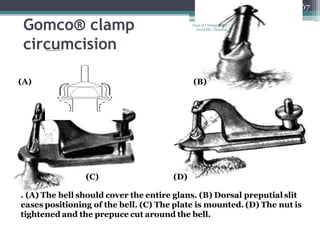 Gomco® clamp
circumcision
. (A) The bell should cover the entire glans. (B) Dorsal preputial slit
eases positioning of the bell. (C) The plate is mounted. (D) The nut is
tightened and the prepuce cut around the bell.
(A) (B)
(C) (D)
67
Dept of Urology, GRH
and KMC, Chennai.
 