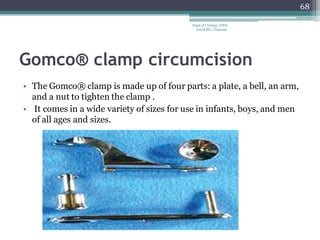 Gomco® clamp circumcision
• The Gomco® clamp is made up of four parts: a plate, a bell, an arm,
and a nut to tighten the clamp .
• It comes in a wide variety of sizes for use in infants, boys, and men
of all ages and sizes.
68
Dept of Urology, GRH
and KMC, Chennai.
 