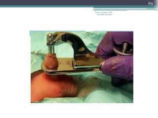 69
Dept of Urology, GRH
and KMC, Chennai.
 