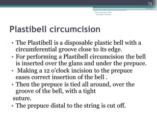 Plastibell circumcision
• The Plastibell is a disposable plastic bell with a
circumferential groove close to its edge.
• For performing a Plastibell circumcision the bell
is inserted over the glans and under the prepuce.
• Making a 12 o’clock incision to the prepuce
eases correct insertion of the bell .
• Then the prepuce is tied all around, over the
groove of the bell, with a tight
suture.
• The prepuce distal to the string is cut off.
73
Dept of Urology, GRH
and KMC, Chennai.
 