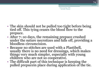 • The skin should not be pulled too tight before being
tied off. This tying ceases the blood flow to the
prepuce.
• After 7–10 days, the remaining prepuce crushed
under the suture necrotizes and falls off, providing a
bloodless circumcision.
• Because no stitches are used with a Plastibell,
usually there is no need for dressings, which makes
things very much simpler, especially with young
children who are not so cooperative.
• The difficult part of this technique is keeping the
pulled prepucein place during application of the tie.
74
Dept of Urology, GRH
and KMC, Chennai.
 