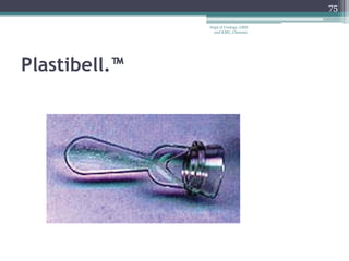 Plastibell.™
75
Dept of Urology, GRH
and KMC, Chennai.
 