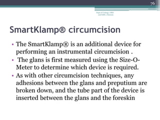 SmartKlamp® circumcision
• The SmartKlamp® is an additional device for
performing an instrumental circumcision .
• The glans is first measured using the Size-O-
Meter to determine which device is required.
• As with other circumcision techniques, any
adhesions between the glans and preputium are
broken down, and the tube part of the device is
inserted between the glans and the foreskin
76
Dept of Urology, GRH
and KMC, Chennai.
 