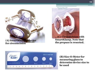 .. (C) Circumcision with
SmartKlamp. Note that
the prepuce is resected.
(A) SmartKlamp® device
for circumcision
(B) Size-O-Meter for
measuring glans to
determine device size to
be used
78
Dept of Urology, GRH
and KMC, Chennai.
 