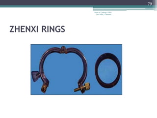 ZHENXI RINGS
79
Dept of Urology, GRH
and KMC, Chennai.
 