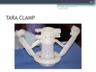 TARA CLAMP
80
Dept of Urology, GRH
and KMC, Chennai.
 