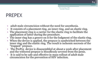 PREPEX
• adult male circumcision without the need for anesthesia.
• It consists of a placement ring, an inner ring, and an elastic ring.
• The placement ring is a carrier for the elastic ring to facilitate the
application of latter during the procedure.
• The inner ring has a groove on it for the lodgment of the elastic ring.
• When the device is applied, the prepuce is sandwiched between the
inner ring and the elastic ring. The result is ischemic necrosis of the
“trapped” prepuce.
• The PrePex device is disassembled at about a week after placement
and the withered prepuce is bloodlessly severed from the penis.
• It is said to be safe and effective in mass rollout of adult male
circumcision for the prevention of HIV infection.
84
Dept of Urology, GRH
and KMC, Chennai.
 