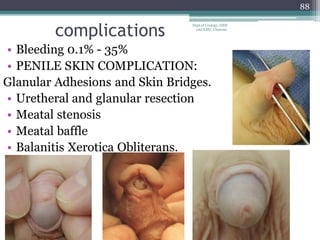• Bleeding 0.1% - 35%
• PENILE SKIN COMPLICATION:
Glanular Adhesions and Skin Bridges.
• Uretheral and glanular resection
• Meatal stenosis
• Meatal baffle
• Balanitis Xerotica Obliterans.
complications
88
Dept of Urology, GRH
and KMC, Chennai.
 