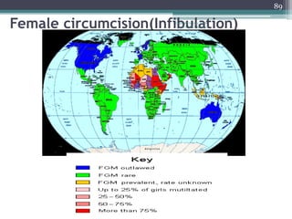 Female circumcision(Infibulation)
89
Dept of Urology, GRH
and KMC, Chennai.
 