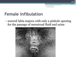 Female infibulation
• scarred labia majora with only a pinhole opening
for the passage of menstrual fluid and urine
92
Dept of Urology, GRH
and KMC, Chennai.
 