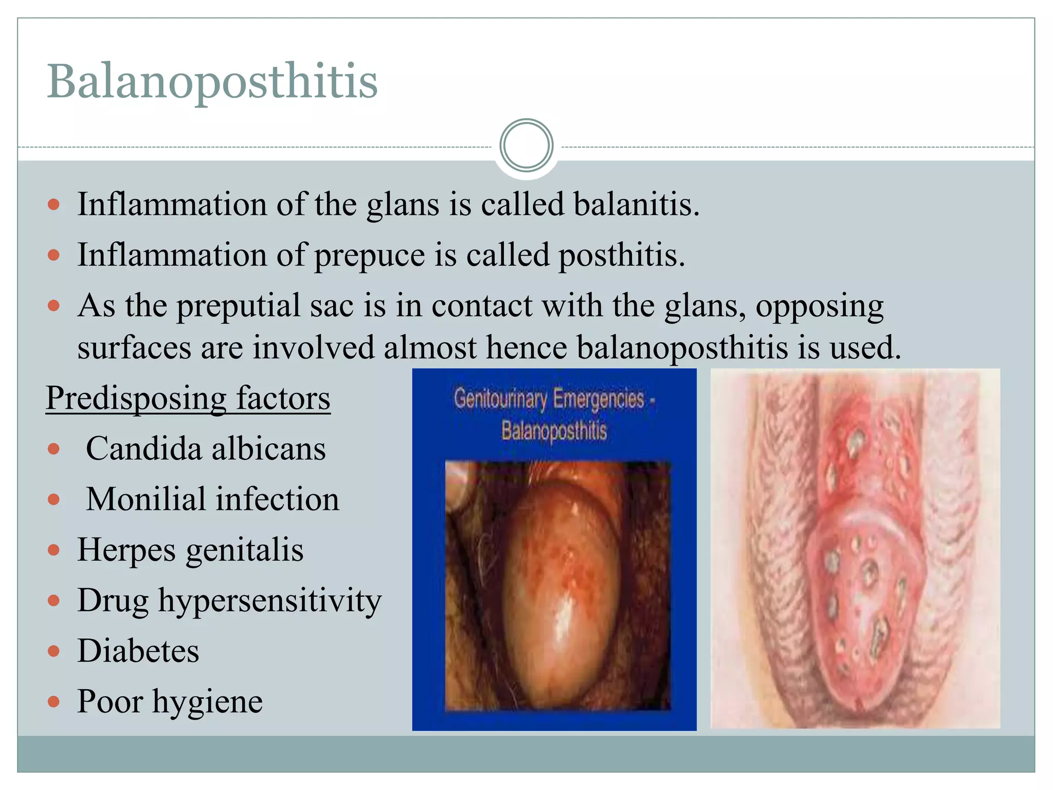 Penis & disorders | PPTX