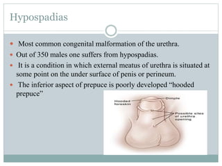Hypospadias
 Most common congenital malformation of the urethra.
 Out of 350 males one suffers from hypospadias.
 It is a condition in which external meatus of urethra is situated at
some point on the under surface of penis or perineum.
 The inferior aspect of prepuce is poorly developed “hooded
prepuce”
 