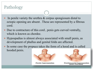 Pathology
 In penile variety the urethra & corpus spongiosum distal to
ectopic opening are absent . These are represented by a fibrous
cord.
 Due to contracture of this cord , penis gets curved ventrally,
which is known as chordee.
 Hypospadias is almost always associated with small penis, as
development of phallus and genital folds are affected.
 In some case the prepuce takes the form of a hood and is called
hooded penis.
 