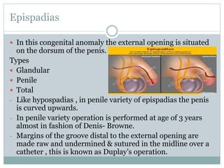 Epispadias
 In this congenital anomaly the external opening is situated
on the dorsum of the penis.
Types
 Glandular
 Penile
 Total
- Like hypospadias , in penile variety of epispadias the penis
is curved upwards.
- In penile variety operation is performed at age of 3 years
almost in fashion of Denis- Browne.
- Margins of the groove distal to the external opening are
made raw and undermined & sutured in the midline over a
catheter , this is known as Duplay’s operation.
 