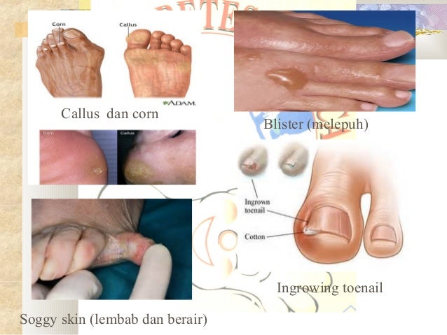 Ubat Jari Kaki Melecet - Bertanya b