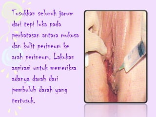 Tusukkan seluruh jarum
dari tepi luka pada
perbatasan antara mukosa
dan kulit perineum ke
arah perineum. Lakukan
aspirasi untuk memeriksa
adanya darah dari
pembuluh darah yang
tertusuk.
 