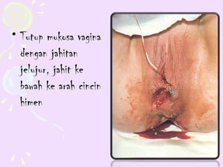 • Tutup mukosa vagina
  dengan jahitan
  jelujur, jahit ke
  bawah ke arah cincin
  himen
 