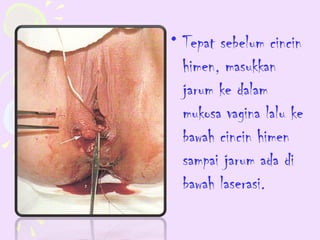 • Tepat sebelum cincin
  himen, masukkan
  jarum ke dalam
  mukosa vagina lalu ke
  bawah cincin himen
  sampai jarum ada di
  bawah laserasi.
 
