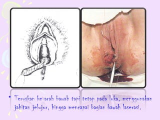 • Teruskan ke arah bawah tapi tetap pada luka, menggunakan
  jahitan jelujur, hingga mencapai bagian bawah laserasi.
 