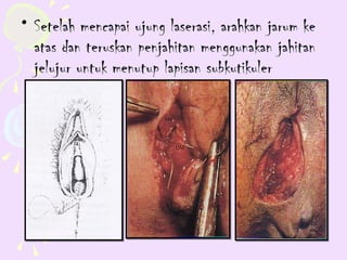 • Setelah mencapai ujung laserasi, arahkan jarum ke
  atas dan teruskan penjahitan menggunakan jahitan
  jelujur untuk menutup lapisan subkutikuler
 