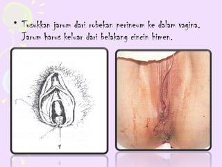 • Tusukkan jarum dari robekan perineum ke dalam vagina.
  Jarum harus keluar dari belakang cincin himen.
 
