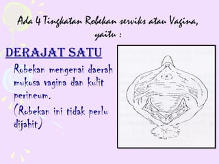 Ada 4 Tingkatan Robekan serviks atau Vagina,
                    yaitu :
dERAJAT sATU
 Robekan mengenai daerah
 mukosa vagina dan kulit
 perineum.
 (Robekan ini tidak perlu
 dijahit)
 