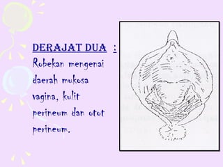 dERAJAT dUA :
Robekan mengenai
daerah mukosa
vagina, kulit
perineum dan otot
perineum.
 