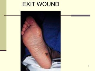 19
EXIT WOUND
 