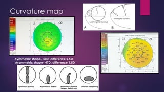 Curvature map
Symmetric shape- 50D, difference 2.5D
Asymmetric shape- 47D, difference 1.5D
 