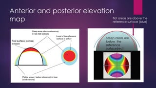 Anterior and posterior elevation
map
Steep areas are
below the
reference
surface(red)
flat areas are above the
reference surface (blue)
 