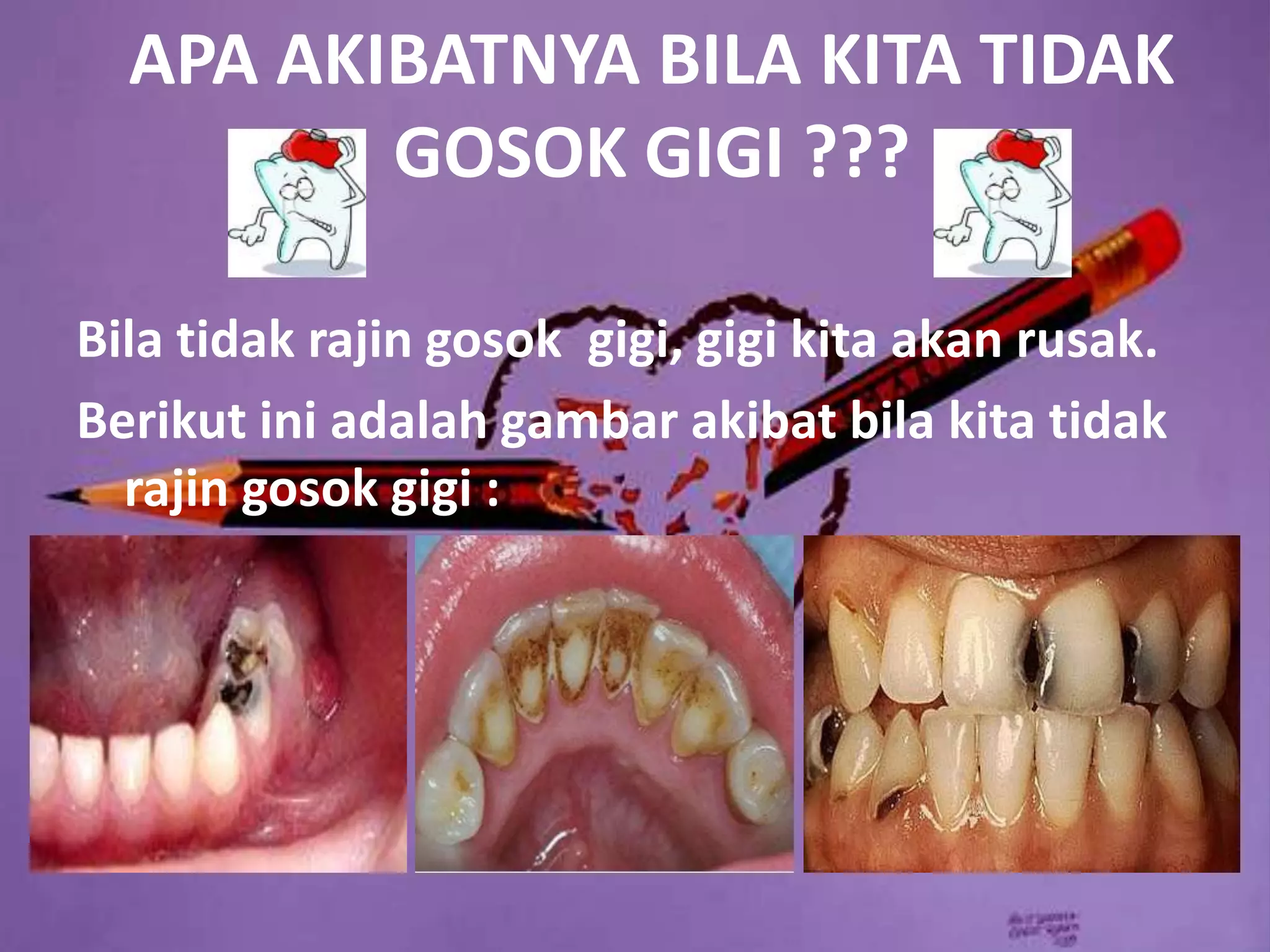 APA AKIBATNYA BILA KITA TIDAK
         GOSOK GIGI ???

Bila tidak rajin gosok gigi, gigi kita akan rusak.
Berikut ini adalah gambar akibat bila kita tidak
  rajin gosok gigi :
 