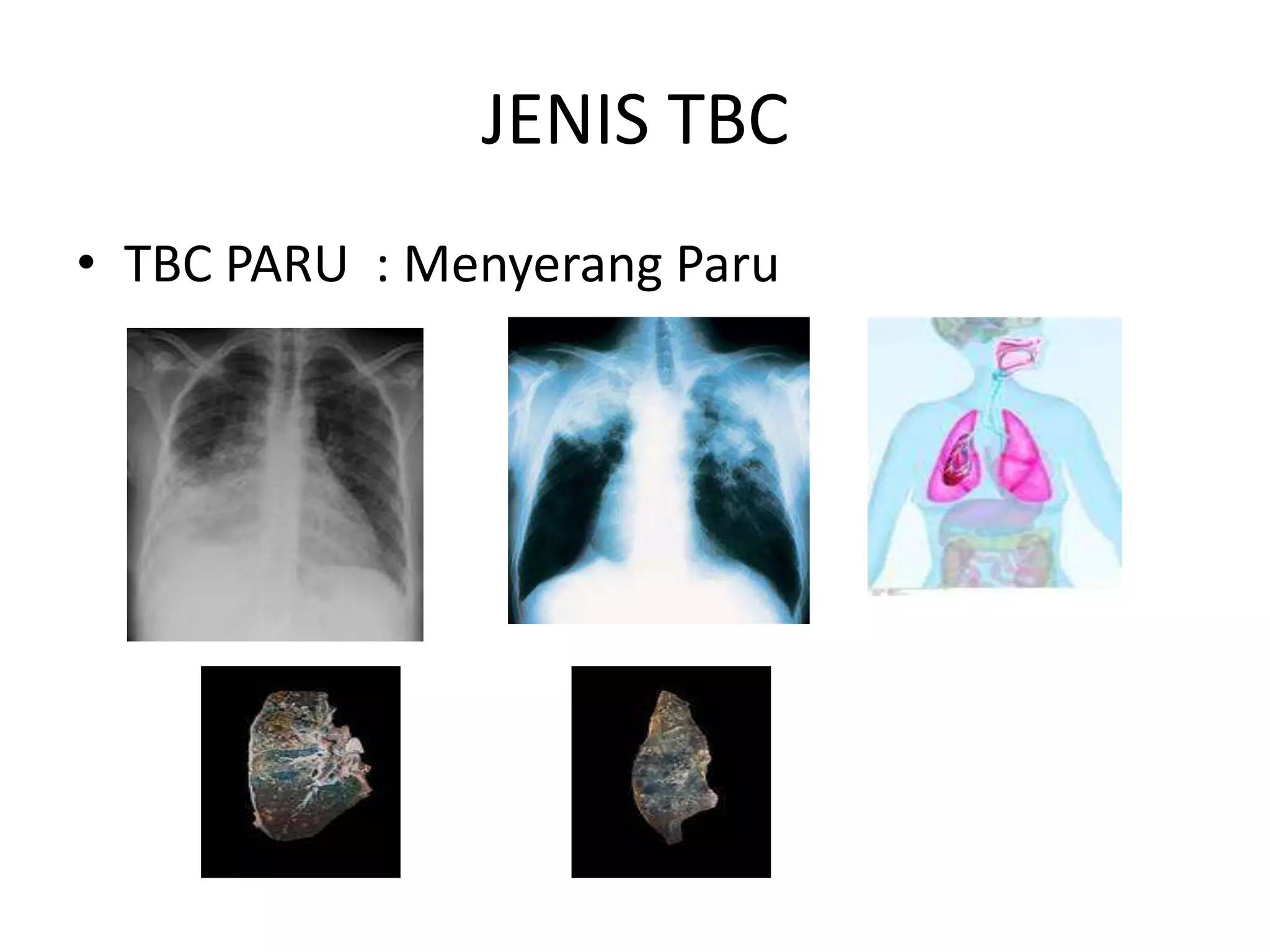 JENIS TBC
• TBC PARU : Menyerang Paru
 