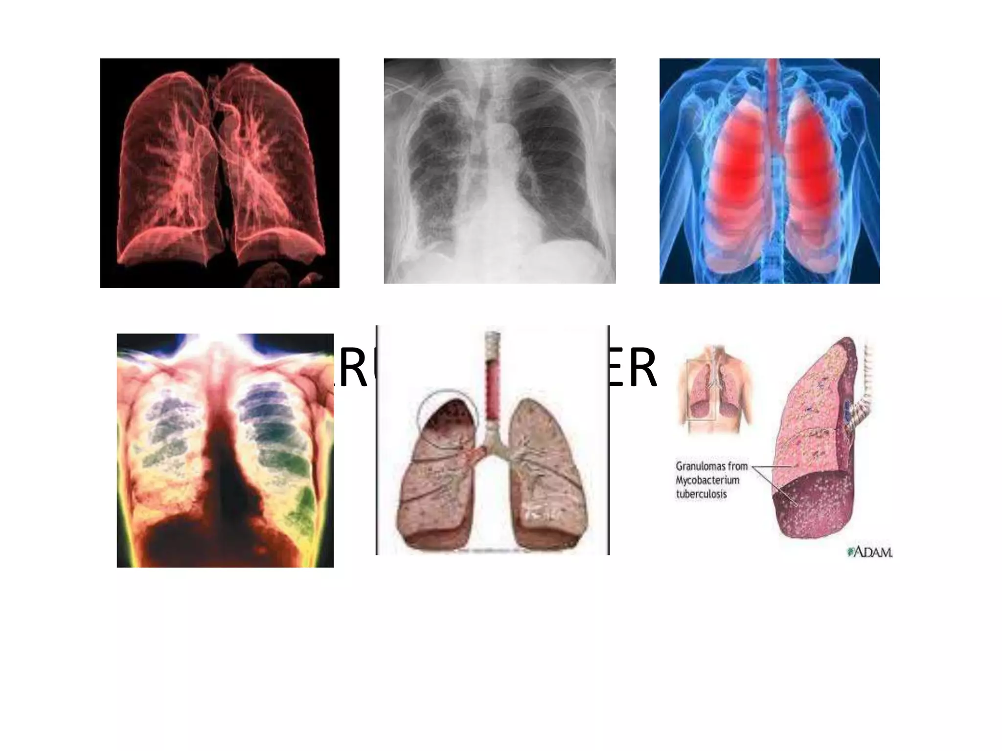 PARU-PARU YG TERERANG TBC
 