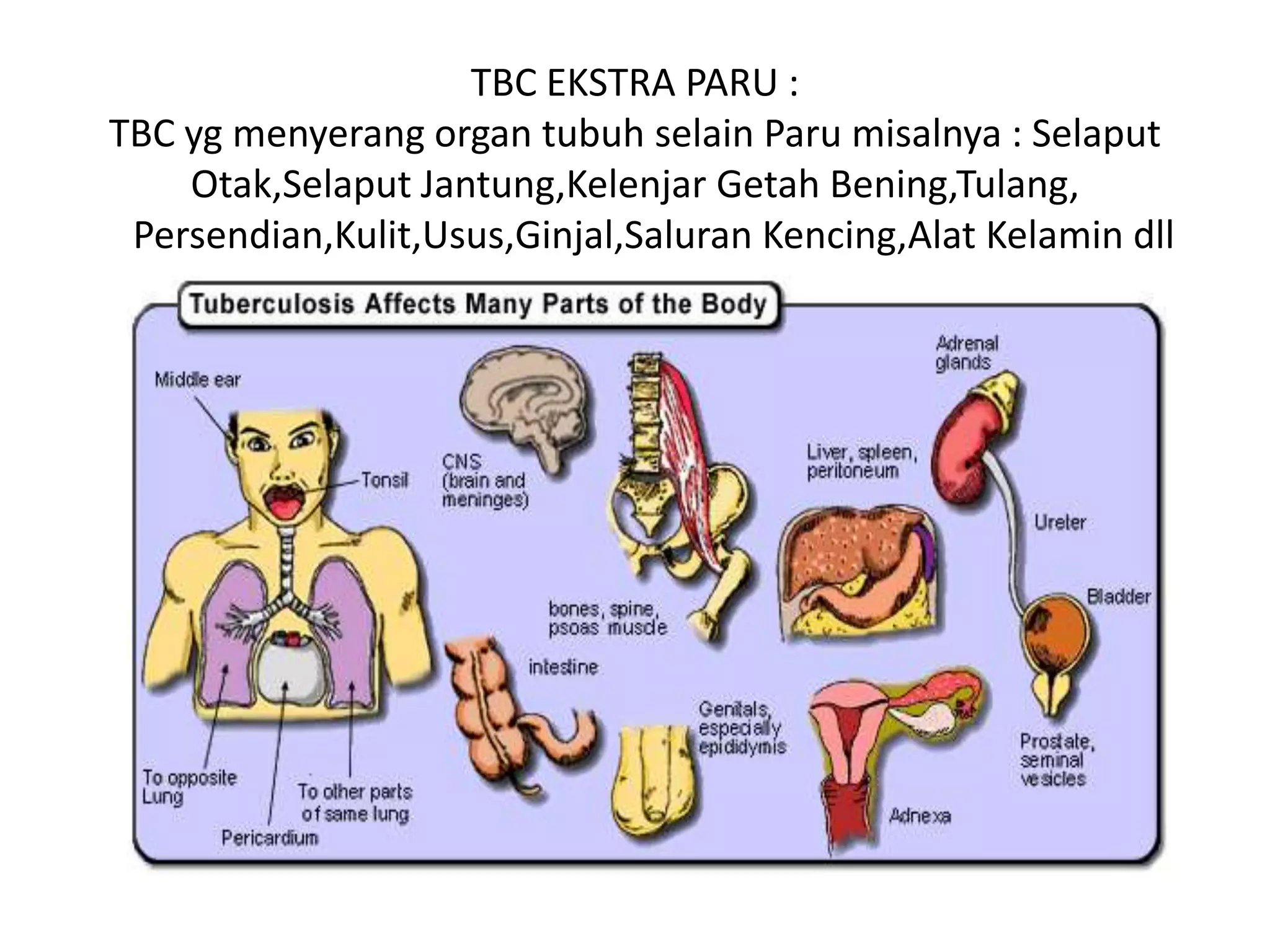 TBC EKSTRA PARU :
TBC yg menyerang organ tubuh selain Paru misalnya : Selaput
Otak,Selaput Jantung,Kelenjar Getah Bening,Tulang,
Persendian,Kulit,Usus,Ginjal,Saluran Kencing,Alat Kelamin dll
 