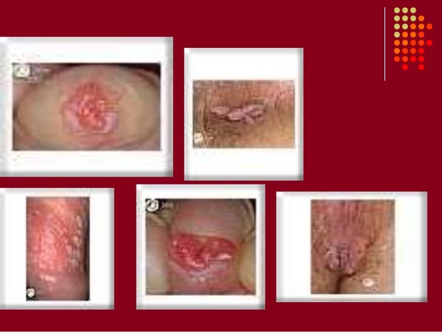 Image Result For Penyakit Menular Image Result For Penyakit Menular