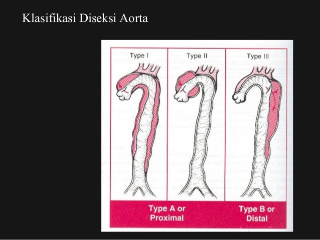 Penyakit aorta awam