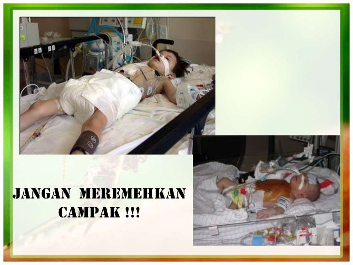 Tanda-Tanda Demam Campak / Ubat Penyakit Demam Denggi - Seratus c