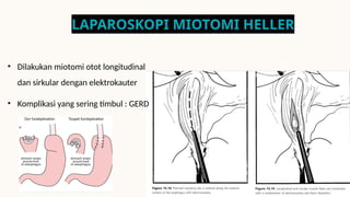 Miotomi Ruke PENYAKIT ESOFAGUS (Kuliah SSS2-K25).pptx